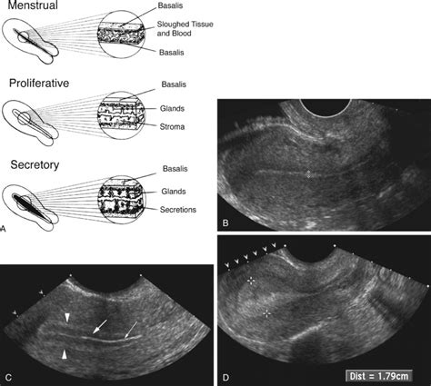 anteverted uterus with thin endometrium means|Anteverted Uterus – Radiology In Plain English.